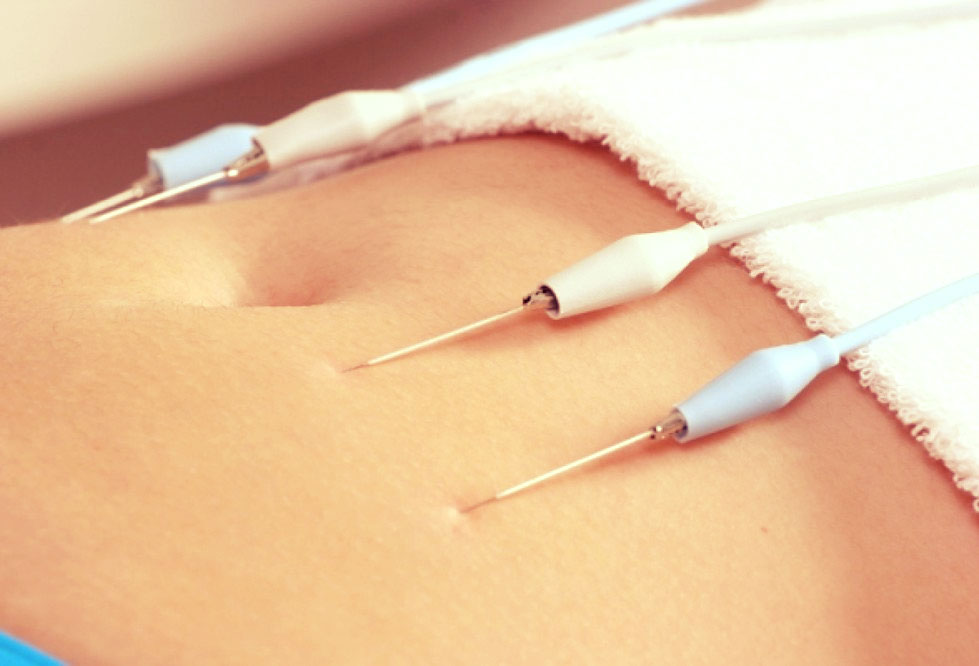 Curso de Eletroestética em Niterói – Matricule-se Já!